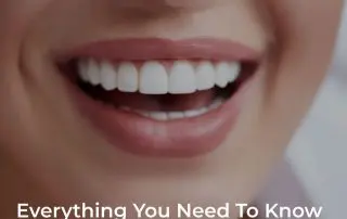 Everything You Need To Know About Veneers In Clearwater