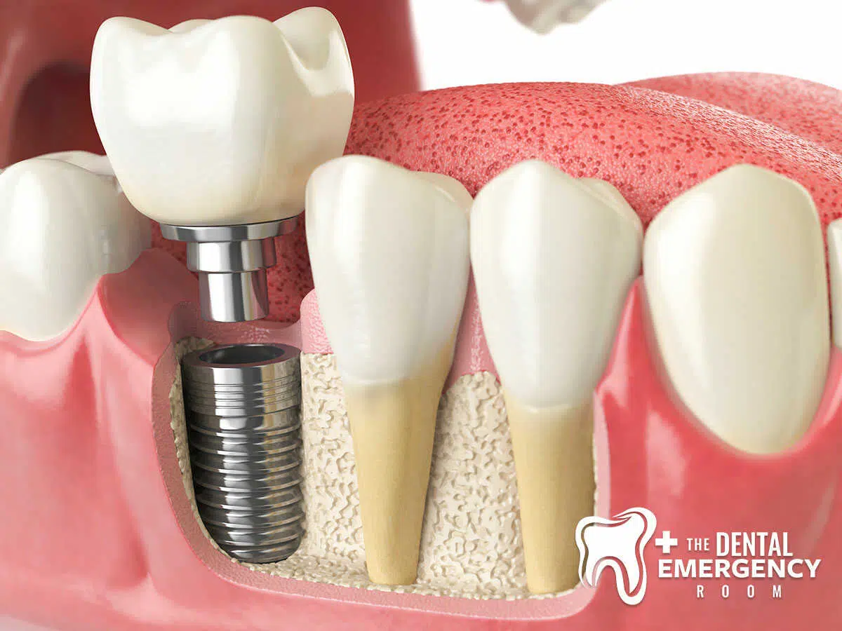 How Dental Implants & Crowns Can Replace Missing Teeth in Clearwater, FL.