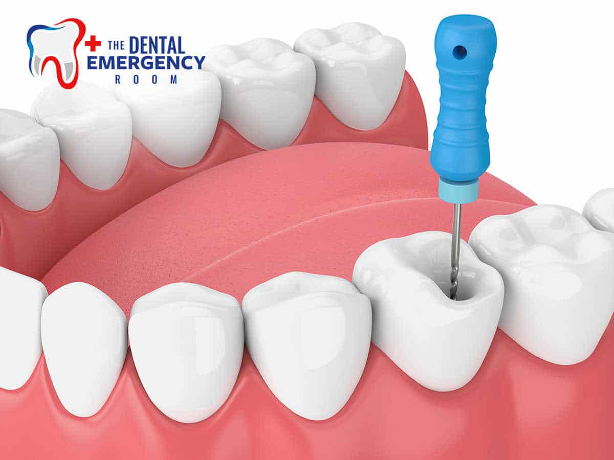 Demostration Of a Root Canal Procedure In Dental ER, Florida