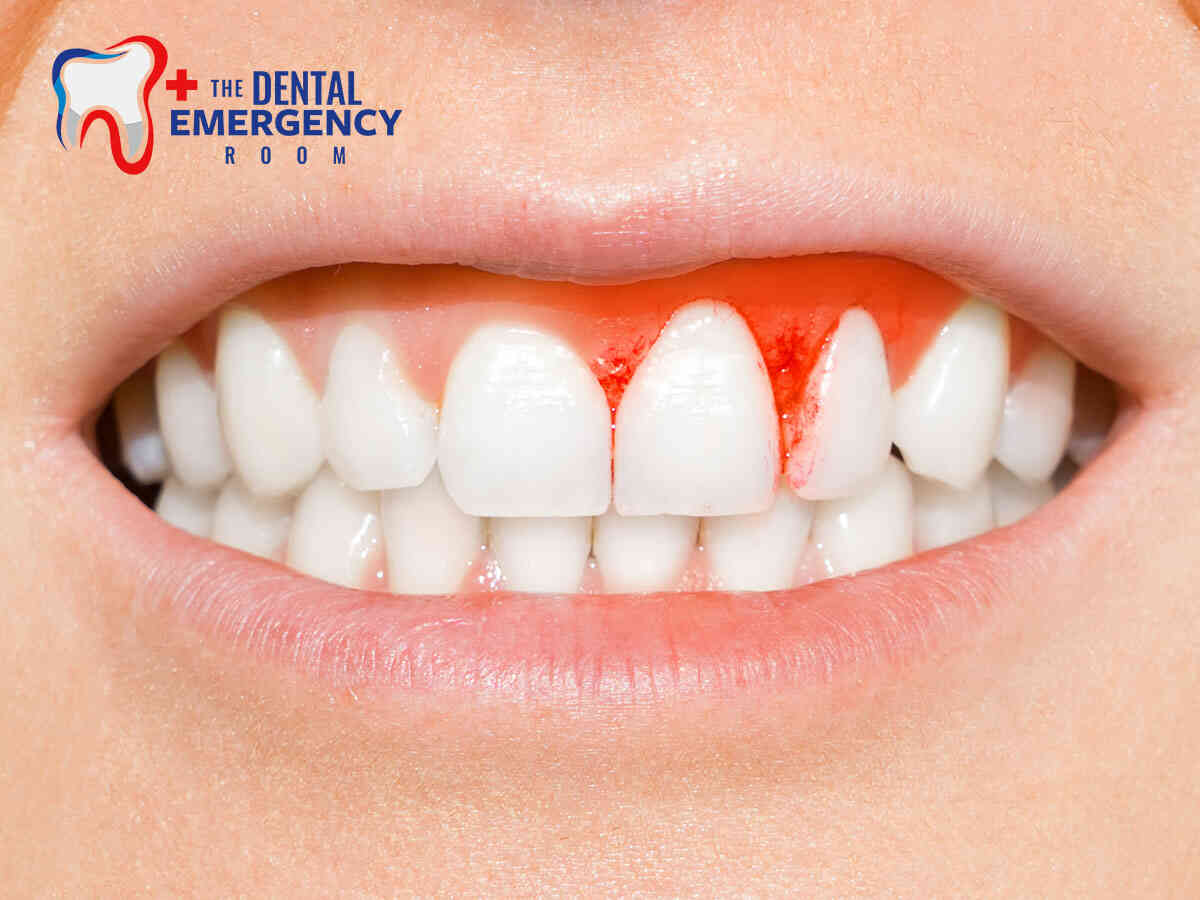Five Common Reasons You May Need To Have a Tooth Pulled Immediately In Dental ER, Florida