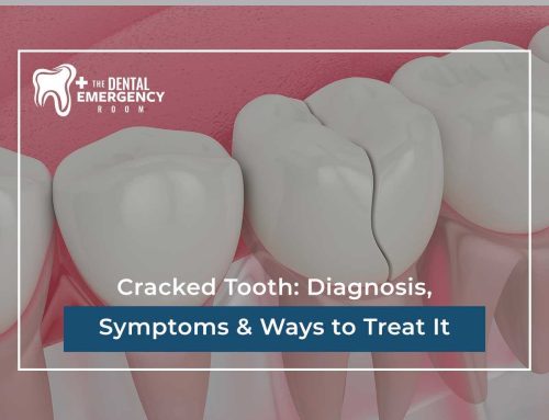 Cracked Tooth: Diagnosis, Symptoms & Ways to Treat It
