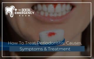 How To Treat Periodontitis Causes, Symptoms & Treatment