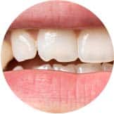 Clearwater Dental Veneers Fixes Broken Or Chipped Tooth After An Accident