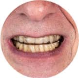 Clearwater Dental Veneers Conceals Dark Colored And Stained Teeth