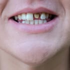 Emergency Dentistry For Cracked Or Broken Teeth Near Largo, FL