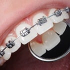 Emergency Dentistry For Pain Caused By Orthodontic Appliances Near Largo, FL