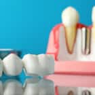 Emergency Dentistry For Broken Crowns, Bridges Or Dentures Near Largo, FL