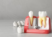 Step 4: Crown Attachment On The Dental Implants