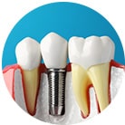 Step 1: Longlasting Permanent Dental Implants Near Largo