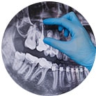 Step 2: Computer Guided Tooth Implant Procedures Near Largo