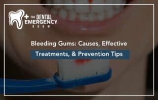 Bleeding Gums: Causes, Effective Treatments, & Prevention Tips